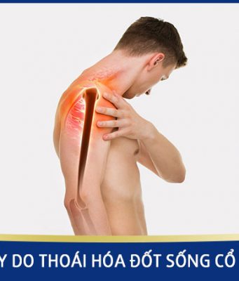 Tê tay do thoái hóa đốt sống cổ: Điều trị như thế nào? Điều trị tê tay do thoái hóa đốt sống cổ