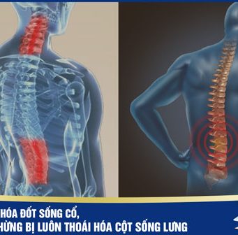 Bị thoái hóa đốt sống cổ, coi chừng thoái hóa luôn cột sống lưng