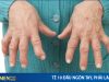 Bị tê 10 đầu ngón tay là bệnh gì ?
