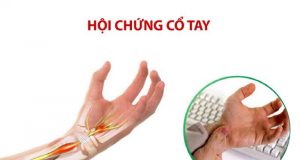 Hội chứng ống cổ tay: Nguyên nhân, chẩn đoán và phương pháp điều trị