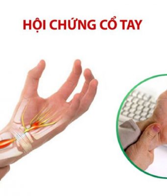 Hội chứng ống cổ tay: Nguyên nhân, chẩn đoán và phương pháp điều trị
