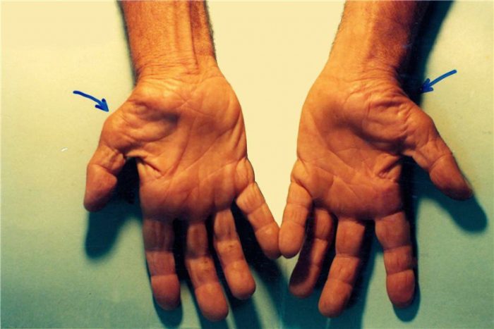 Mổ hội chứng ống cổ tay bao lâu thì lành