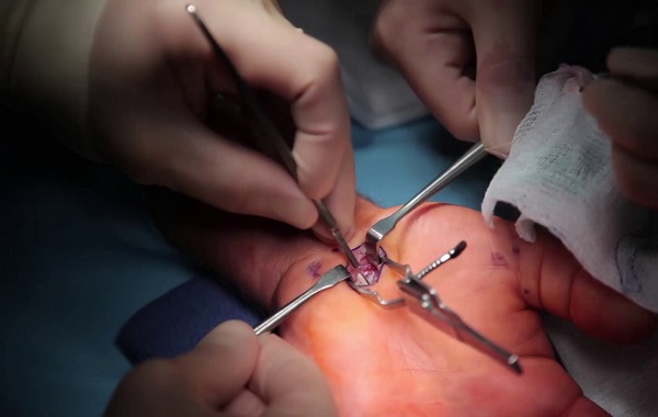 Quy trình phẫu thuật hội chứng ống cổ tay