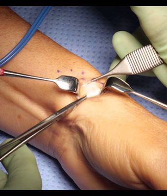 Bạn có biết chi phí phẫu thuật hội chứng ống cổ tay bao nhiêu tiền?