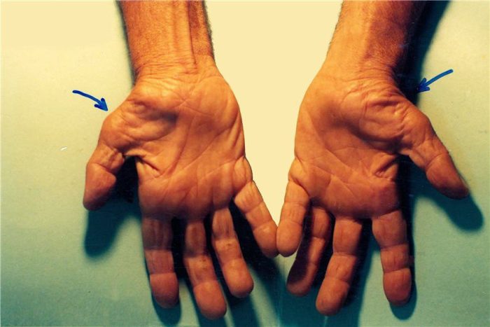 Chăm sóc hậu phẫu thuật hội chứng ống cổ tay cần lưu ý gì?