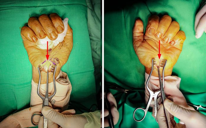 Phương pháp phẫu thuật hội chứng ống cổ tay